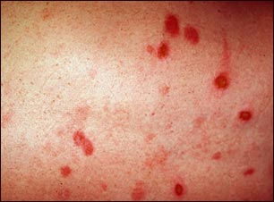 Eritema multiforme en la pierna