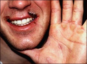 Eritema multiforme en la mano