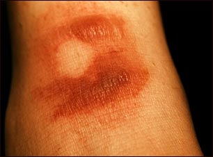 Erupci&oacute;n fija por drogas, bullosa