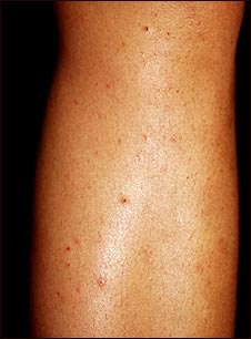 Foliculitis en la pierna