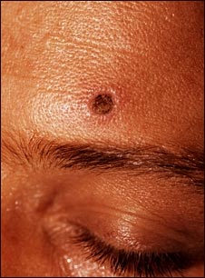 Histoplasmosis, diseminada en paciente HIV