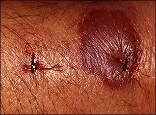 Vista de cerca de una reacci&oacute;n a una picadura de insecto