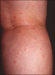 Picaduras de insecto en la pierna