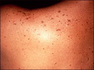 Lentigo solar en la espalda