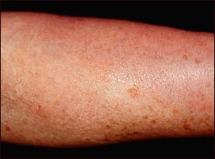 Mastocitosis cut&aacute;nea difusa