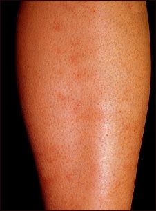 Poliarteritis microsc&oacute;pica en la espinilla