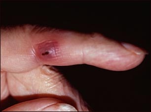 Lesi&oacute;n de Janeway en un dedo