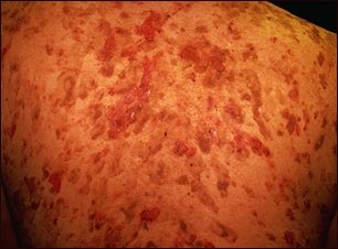 P&eacute;nfigo vulgar en la espalda