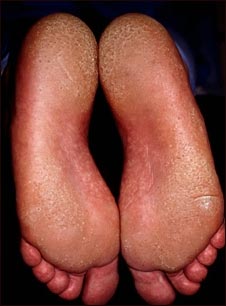 Querat&oacute;lisis punctata