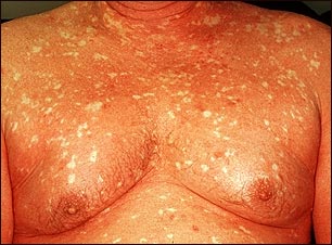 Pitiriasis rubra pilaris en el pecho