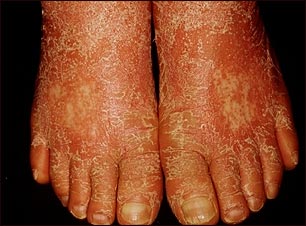 Pitiriasis rubra pilaris en los pies