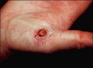 Granuloma piog&eacute;nico en la mano