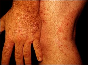 Ti&ntilde;a corporal en la mano y la pierna