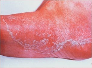 Pie de atleta; ti&ntilde;a podal