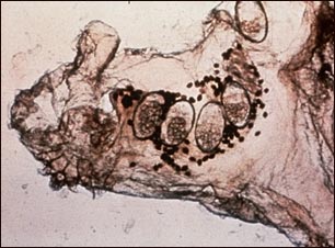 Microfotograf&iacute;a del &aacute;caro de la escabiosis, los huevos y el &aacute;caro en las heces