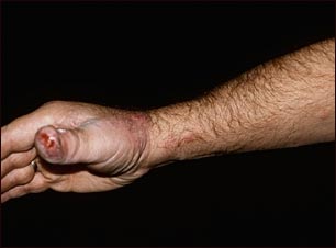 Esporotricosis en la mano y el brazo