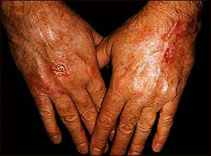 C&aacute;ncer de piel, escamocelular en las manos