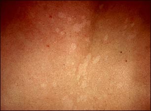 Acercamiento de ti&ntilde;a versicolor