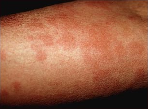 Ronchas (urticaria) en el brazo