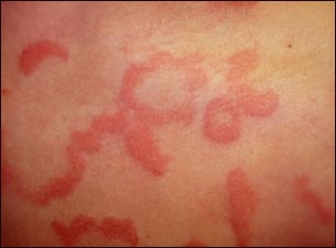 Urticaria - vista de cerca