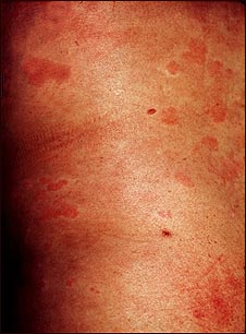 Ronchas (urticaria) en el tronco