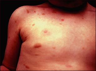 Urticaria pigmentosa en el t&oacute;rax