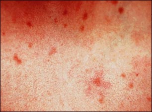 Urticaria pigmentosa; vista de cerca