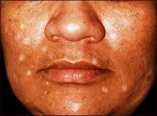 Vit&iacute;ligo inducido por medicamentos