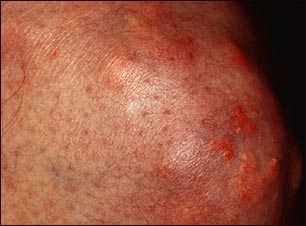 Xantoma de la rodilla