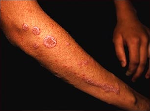 Liquen plano en el brazo