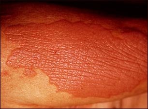 Liquen simple cr&oacute;nico