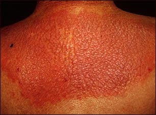 Liquen simple y cr&oacute;nico de la espalda