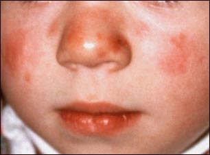 Lupus discoide en el rostro de un ni&ntilde;o