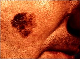 C&aacute;ncer de piel: primer plano del melanoma l&eacute;ntigo maligno