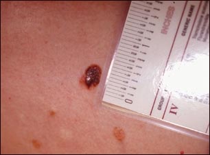 C&aacute;ncer de piel: primer plano del melanoma de nivel III