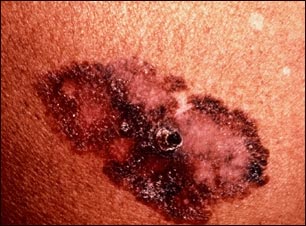 C&aacute;ncer de piel o melanoma de propagaci&oacute;n superficial