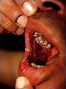 Lesiones orales por p&eacute;nfigo vulgar