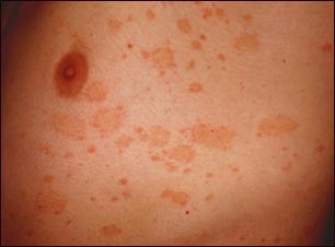 Pitiriasis rosada en el t&oacute;rax