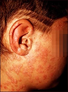 Psoriasis guttata en la mejilla