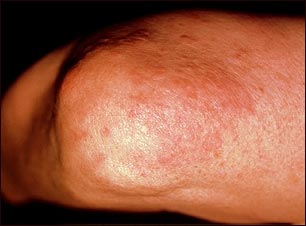 Granuloma anular en el codo