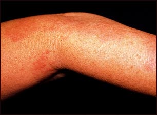 Herpes zoster (culebrilla) en el brazo