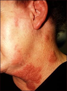 Herpes zoster (culebrilla) en cuello y mejilla