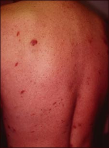 Sarcoma de Kaposi en la espalda