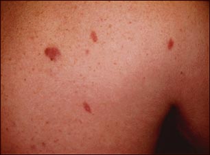 Vista de cerca de sarcoma de Kaposi