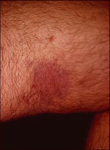 Sarcoma de Kaposi en el muslo