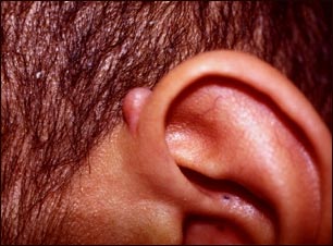 Queloide sobre el o&iacute;do