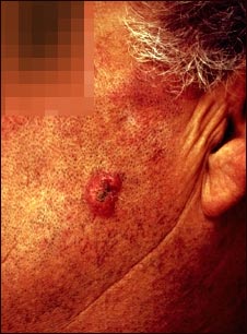 Carcinoma escamocelular invasivo