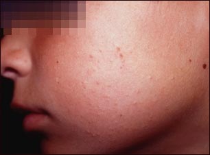 Queratosis pilaris de la mejilla