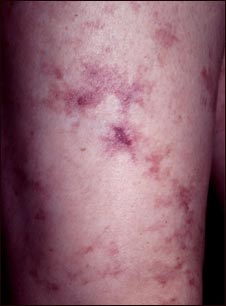 Vista de cerca del livedo reticularis