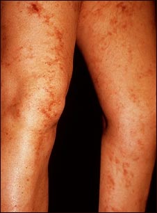 Livedo reticularis en las piernas
